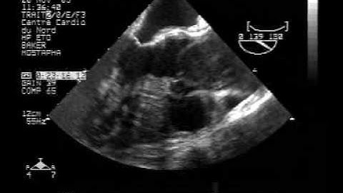 echocardiogram:TEE dissection of the ascending aorta:type A