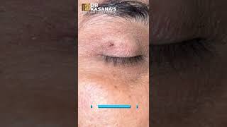 WART REMOVAL Magical Result by DR LALIT KASANA |