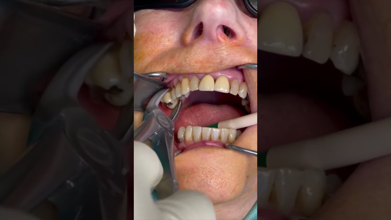 Beautiful Tooth Extraction Painless Dentistry Shorts Health Beauty