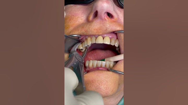 Beautiful tooth extraction | painless dentistry #shorts #health #beauty