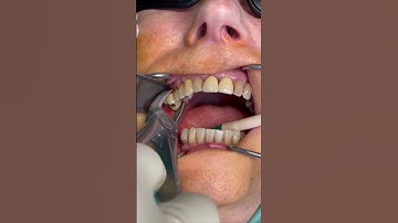 Beautiful tooth extraction | painless dentistry #shorts #health #beauty