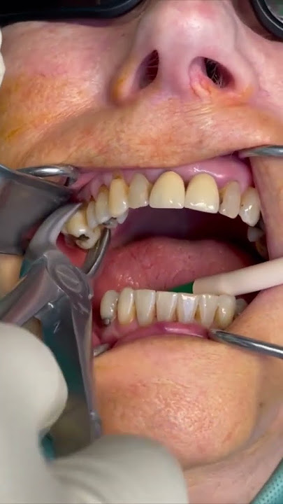 Beautiful tooth extraction | painless dentistry #shorts #health #beauty