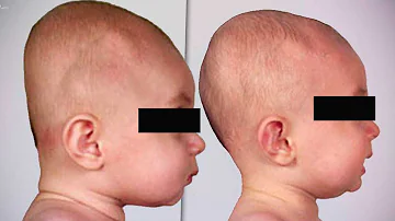 ¿Es necesario cubrir la cabeza del bebé?