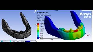 Mandibular Plate Fixation CAD & FEA Simulation| Dental Implant, Maxillofacial Reconstruction: ANSYS