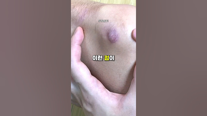 98%가 모르는 이렇게 생긴 점의 위험성