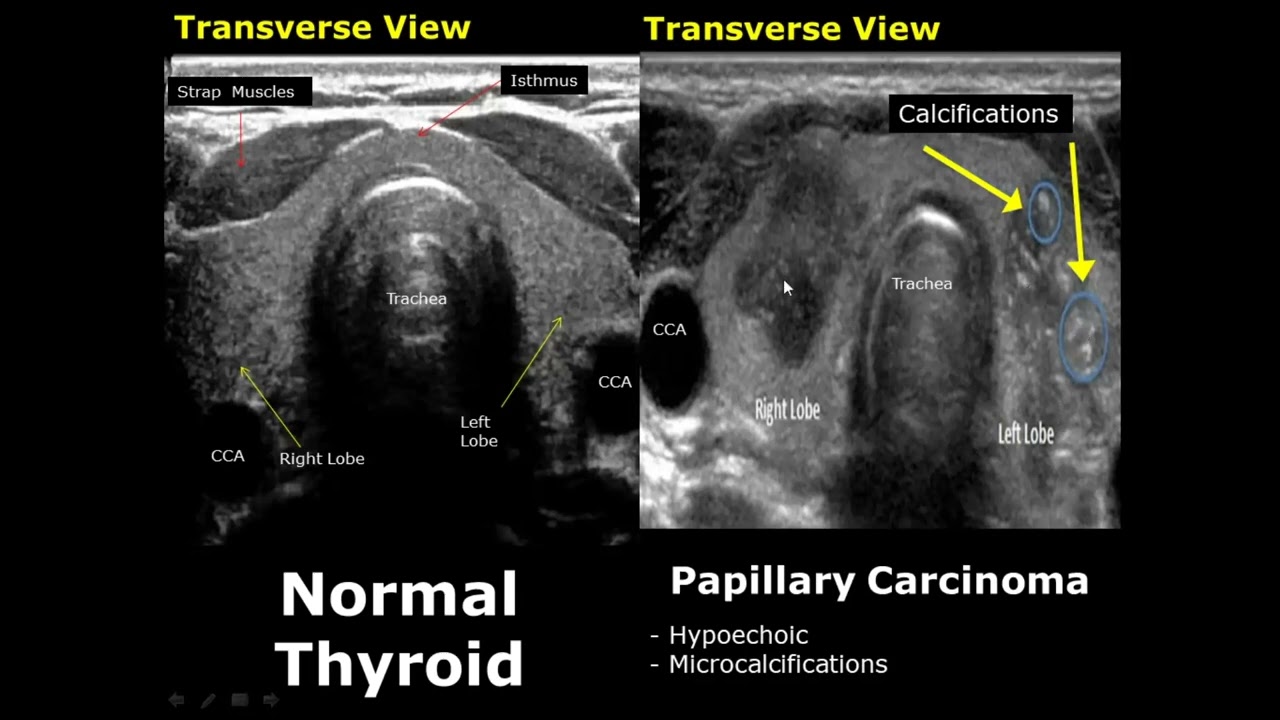 Unhealthy Thyroid Ultrasound