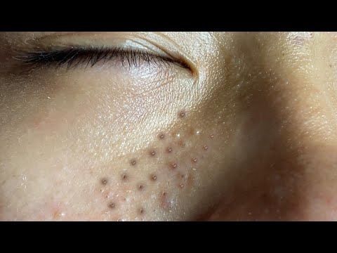 Video Huong Da Nang Acne Treatment (#399) #Huongdanang - youtube