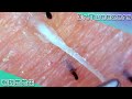 Transparent Wrapped Objects 毛抜き先生の角栓や毛根