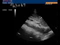 5. aorta abdominal eje largo