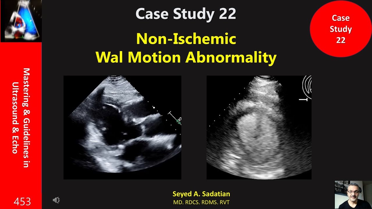 Case Study 22: Non-Ischemic Wal Motion Abnormality