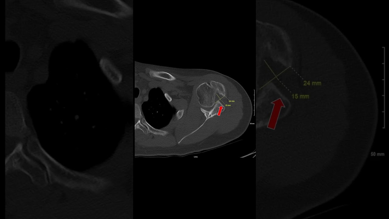 CT of Chronic Shoulder Dislocation 