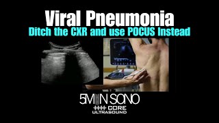 Viral pneumonia – Ditch the CXR and use #POCUS instead