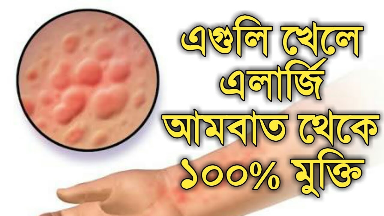 এলার্জি আমবাত থেকে মুক্তির উপায় ঘরোয়া ও হোমিওপ্যাথি | allergy urticaria home & homeopathy bangla