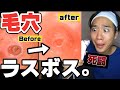 【特大イチゴ鼻】カメラ付き毛穴吸引機で4時間タイマンしてきた。