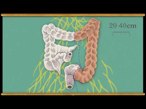 Video: Mutationele Handtekeningen Bij Darmkanker