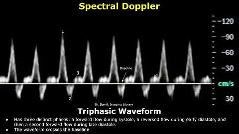 Monophasic, Biphasic & Triphasic Spectral Doppler Waveforms | Vascular Ultrasound Analysis (USG)
