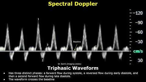 Monophasic, Biphasic & Triphasic Spectral Doppler Waveforms | Vascular Ultrasound Analysis (USG)