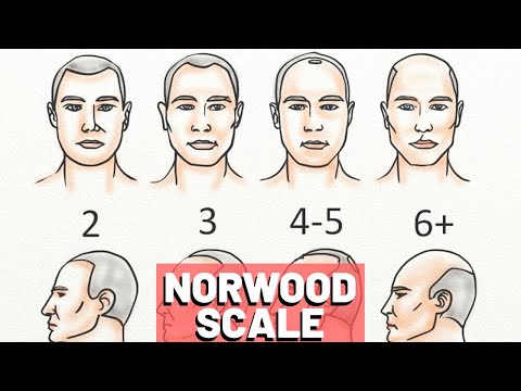 Video: Norwood Scale: Bilder, Stadien, Ursachen Und Behandlung