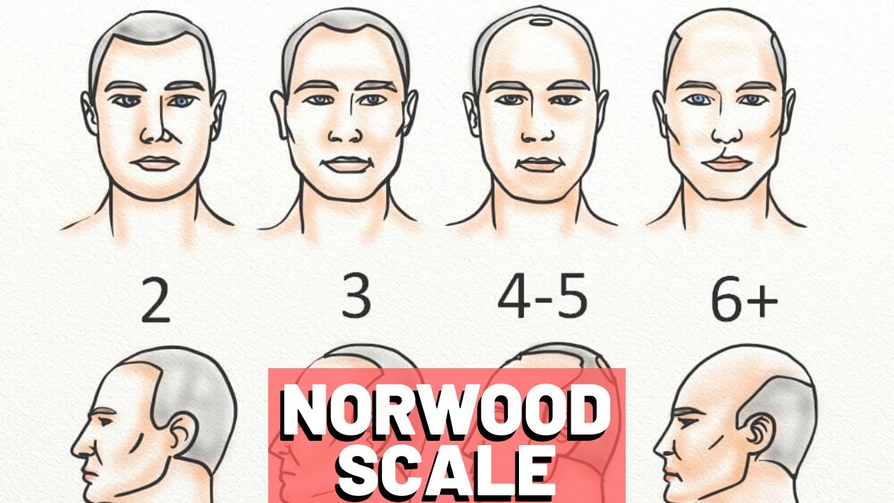 Norwood Chart Pattern Baldness