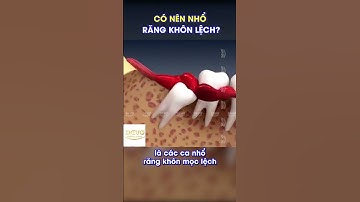 Có nên nhổ răng khôn mọc lêch? (Wisdom tooth extraction)