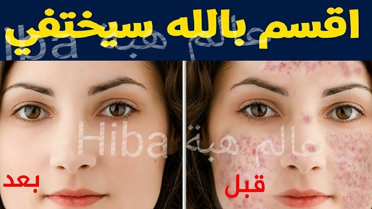 اقسم لكم بالله 10 وصفات متوفرة في كل بيت تخلصك من حب شباب واثاره خلال يوم واحد فقط youtube