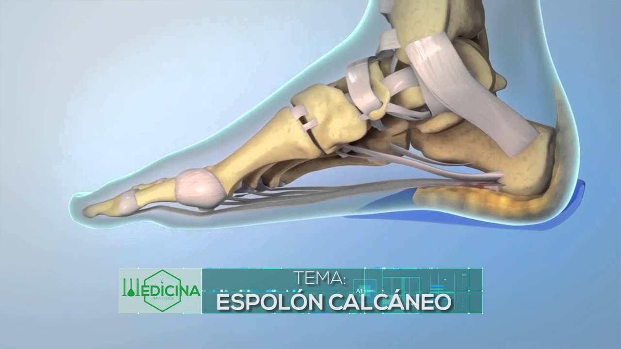Remedios caseros para el espolon calcaneo