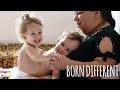 The Twin Sisters Who Share A Body | BORN DIFFERENT