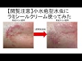 【閲覧注意】水虫にラミシールクリームを使ってみた