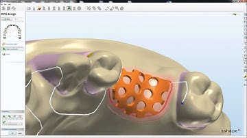 Dental System™ 2010 - Removable Partial Design