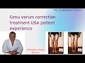 Genu varum correction treatment - USA patient experience