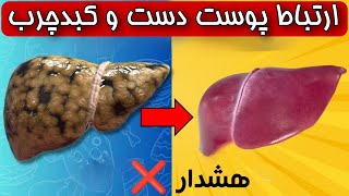 ❌هشدار کبدچرب ❌ این زنگ خطر پوست دستان خود را جدی بگیرید_ارتباط پوست و کبدچرب