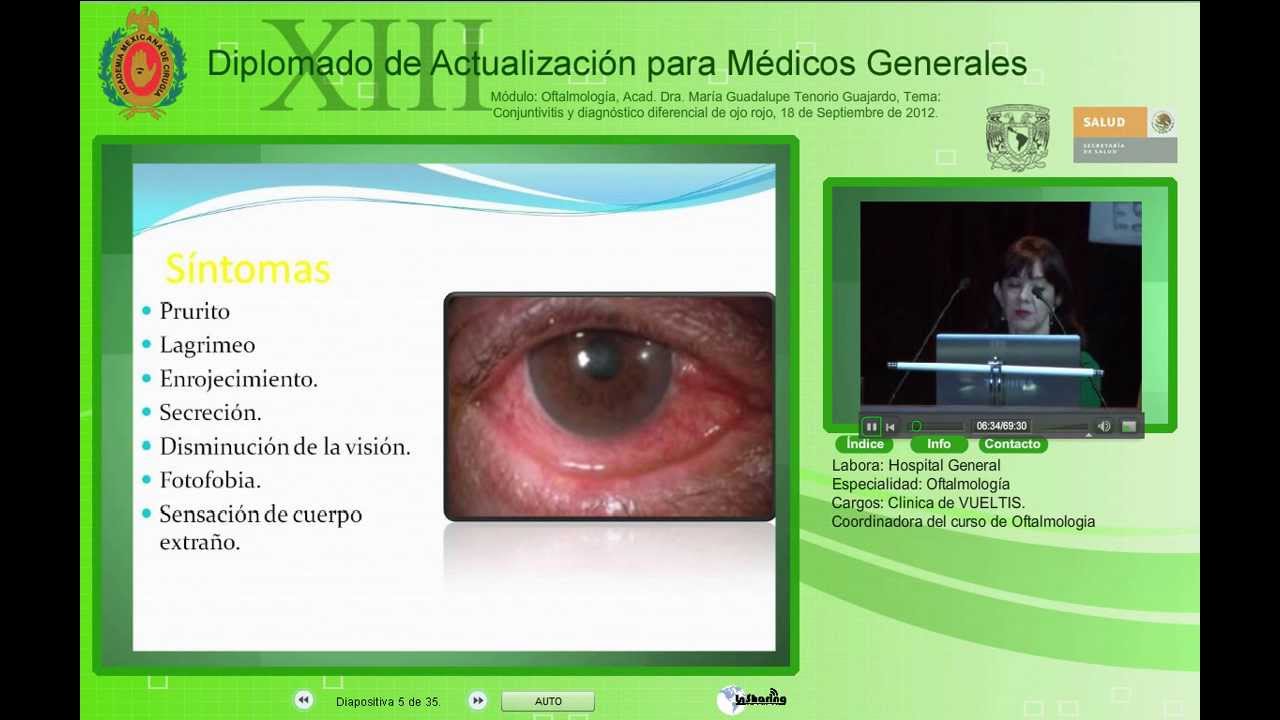 Conjuntivitis y diagnóstico diferencial de ojos rojoAcad