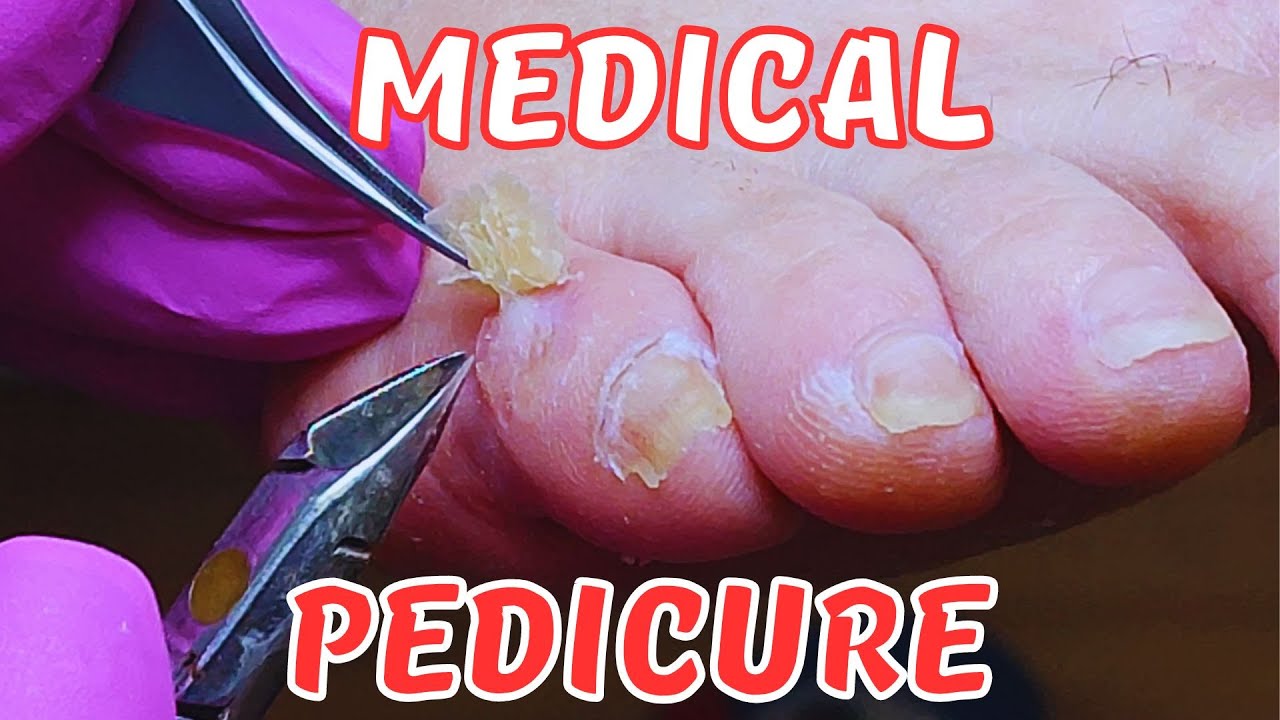 Medical pedicure. Foot corns removal. Calluses YouTube
