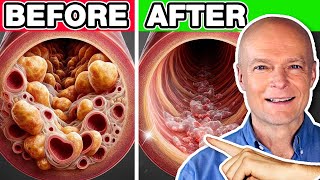 Top 10 Best Vegetables To Unclog Arteries Naturally \& Prevent Heart Attack