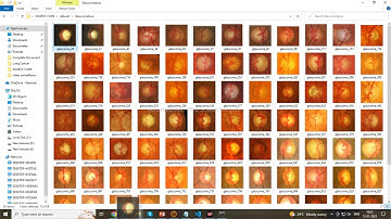 Optical Glaucoma detection using Deep Learning And Streamlit With Segmentation