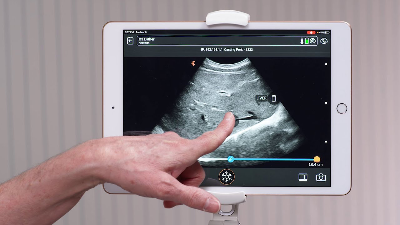 Clarus Normal Clarius Feature: Annotations - YouTube