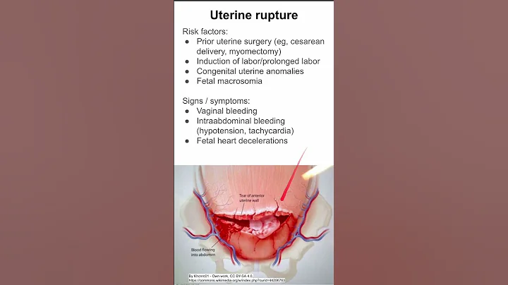 Uterine rupture - DayDayNews