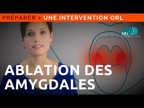 Vidéo: Ablation Des Amygdales : Pour Ou Contre