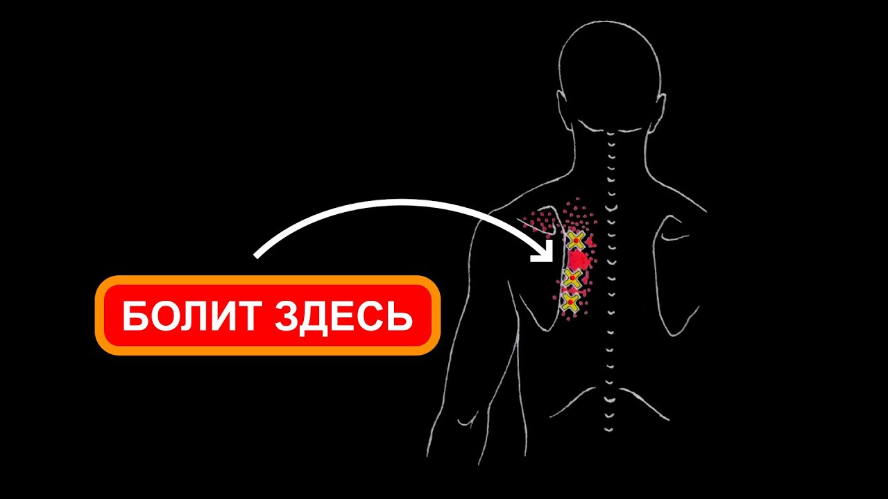 БОЛИТ СПИНА МЕЖДУ ЛОПАТОК 🔴 Большая и малая ромбовидные мышцы ⭐ ...