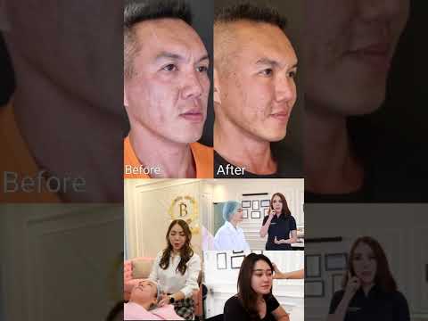 Face Rejuvenation