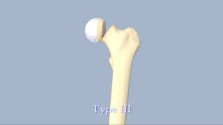 Hip Fractures