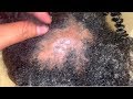 UPDATE: 1 WEEK: Scalp Fungal Infection