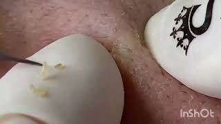 new pimple popping videos blackheads 2023 