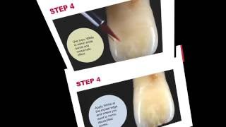 How To Fabricate Winning Dentures Using Idiosyncratic Dentate Characterization