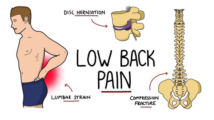 Chronic Low Back Pain 