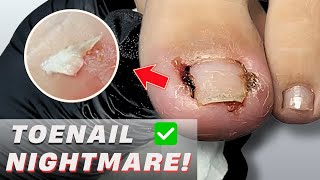 Painful Ingrown Toenail Fixed Without Surgery
