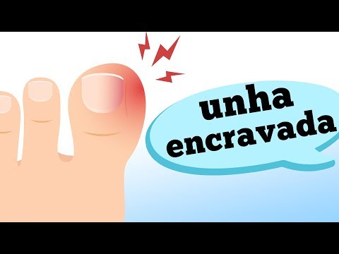 Vídeo: Como encravar o polegar?