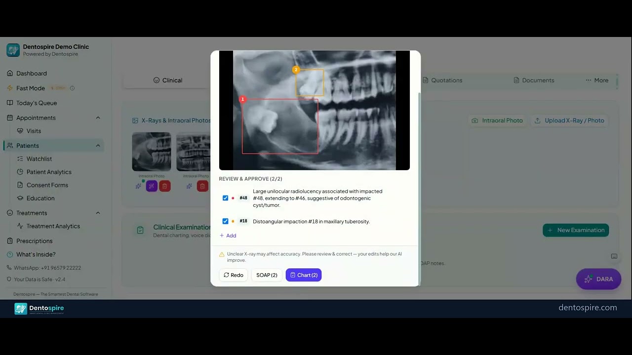 Watch AI highlight areas on a real dental X-ray