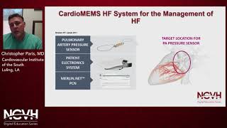 Dr. Christopher Paris, How Cardiomems Can Influence Congestive Heart Failure Outcomes