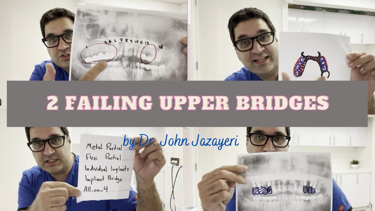 Loose Upper Bridges x2: Partials vs. Implants vs. All-on-4. Which One Do You Choose?